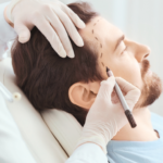 A medical specialist in green gloves using a marker to plan a male patient's new hairline for a hair restoration procedure