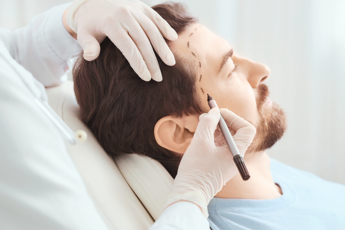A medical specialist in green gloves using a marker to plan a male patient's new hairline for a hair restoration procedure