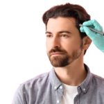 hair transplant in Vietnam specialist marking a patient's hairline for a restoration procedure