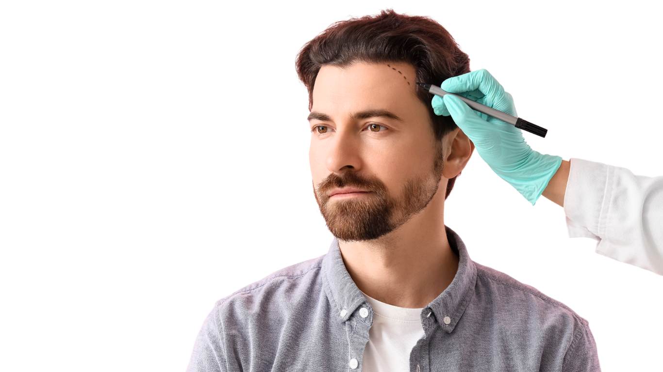 hair transplant in Vietnam specialist marking a patient's hairline for a restoration procedure