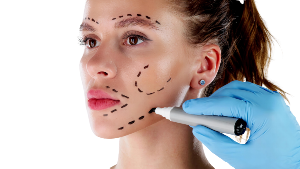 Close-up of a woman’s face with surgical markings for a facial contouring procedure, showcasing professional aesthetic planning in Vietnam.