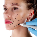 Close-up of a woman’s face with surgical markings for a facial contouring procedure, showcasing professional aesthetic planning in Vietnam.