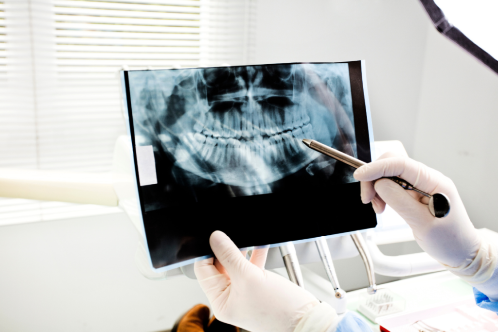 A dentist in white gloves pointing to a digital panoramic dental X-ray, bone graph for dental implants