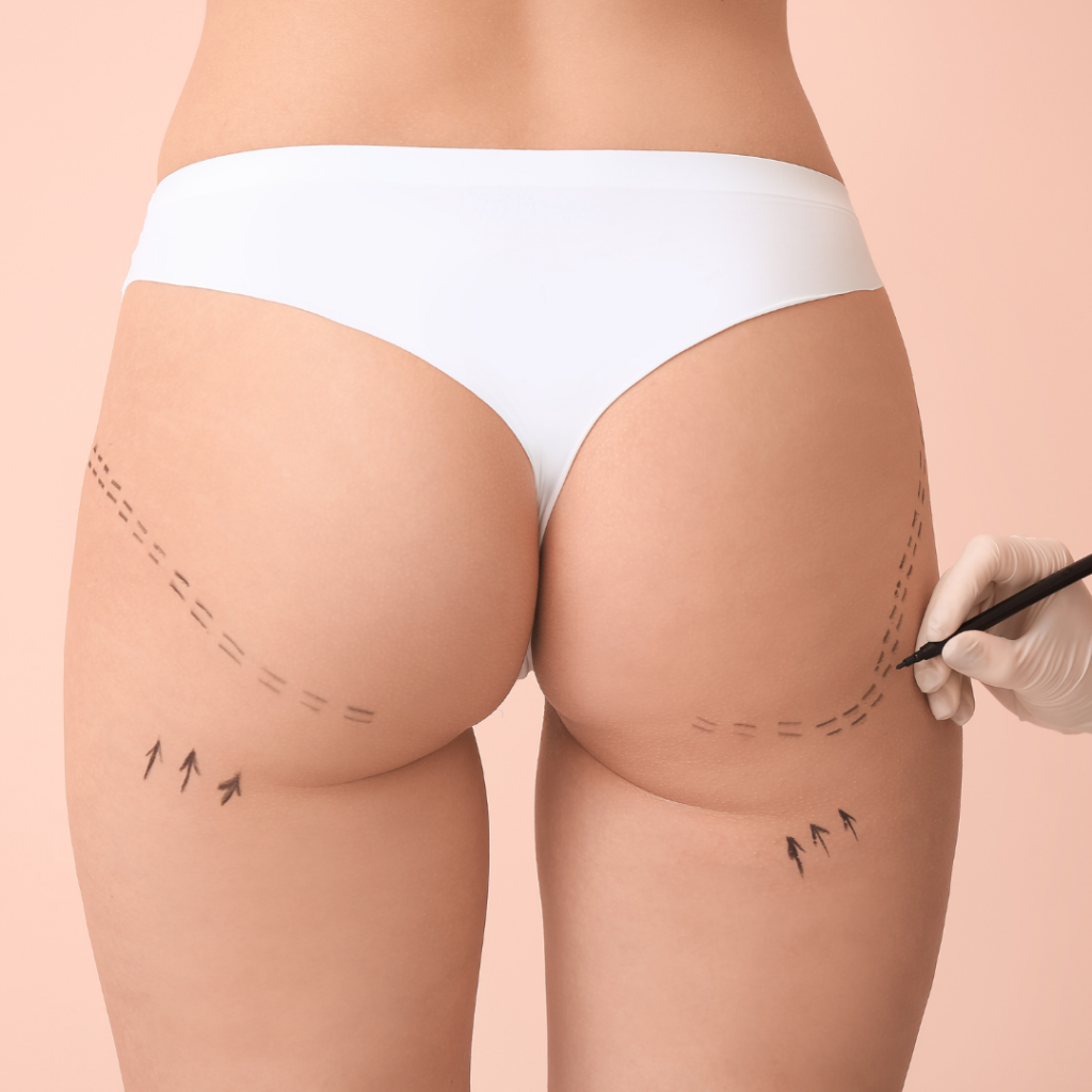 A plastic surgeon using a marker to draw preoperative guidelines for a Brazilian Butt Lift (BBL) surgery, highlighting professional body contouring services in Vietnam.